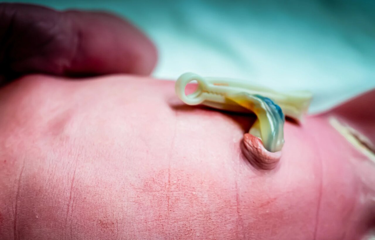 Close-up of a newborn's abdomen with an attached umbilical cord stump and clamp.